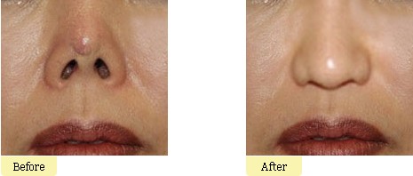 隆鼻失败修复要注意什么