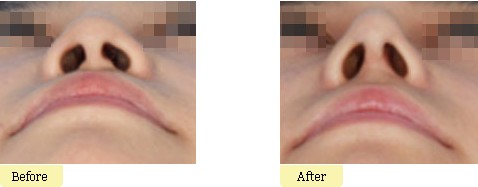 哪些人不适合做隆鼻矫正手术