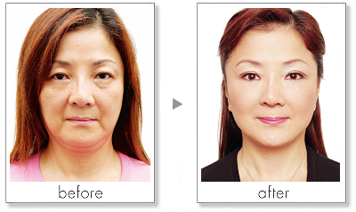 玻尿酸有哪些的美容功效