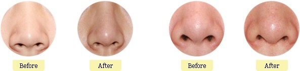 鼻翼缩小术后会留下疤痕吗