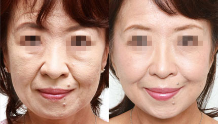 眼袋怎么消除？春节后美眼急救小妙方