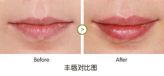 杜太超主任做玻尿酸注射丰唇的效果好吗