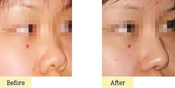 朝天鼻手术价格影响因素有哪些