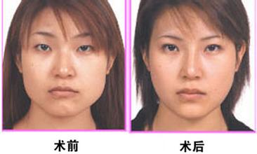 做开眼角手术多久能恢复