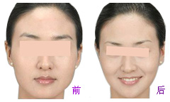 吸脂减肥费用高吗