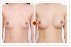 做双环法乳房下垂矫正术需要注意什么