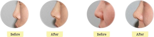 伊凡露注射丰下巴怎么样