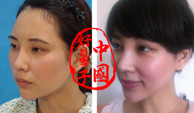 做小切口除皱术有哪些方法