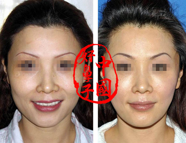 做注射除皱手术要多少钱