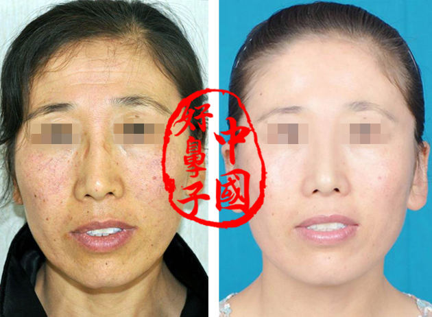 做除皱手术要多少钱