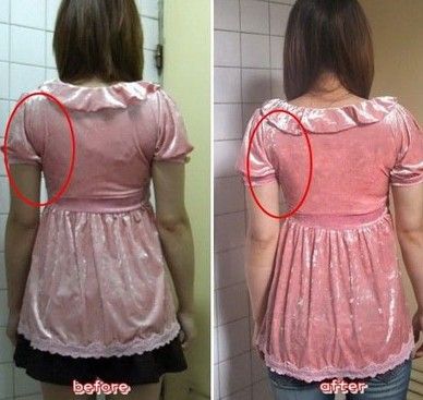 实图直击：网友手臂抽脂经历 