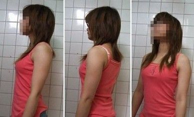 实图直击：网友手臂抽脂经历 