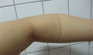 实图直击：网友手臂抽脂经历 