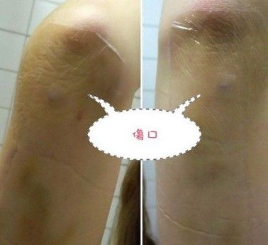 实图直击：网友手臂抽脂经历 