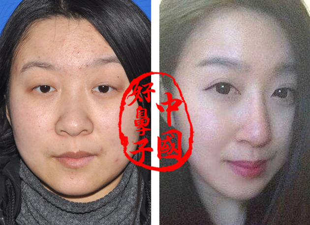 隆鼻术加双眼皮