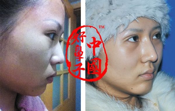 隆鼻术加双眼皮