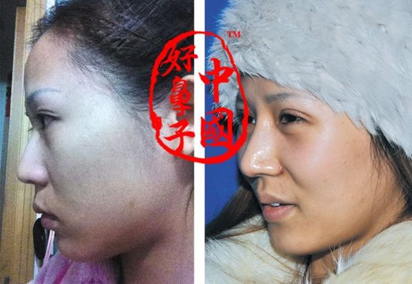 隆鼻术加双眼皮