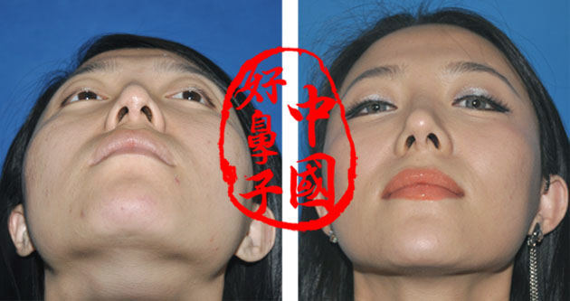 隆鼻术加双眼皮