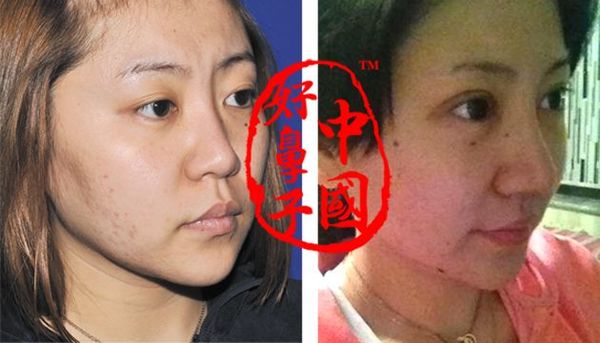 隆鼻术加双眼皮