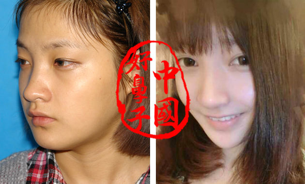 隆鼻术加双眼皮