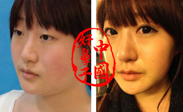 隆鼻术加双眼皮