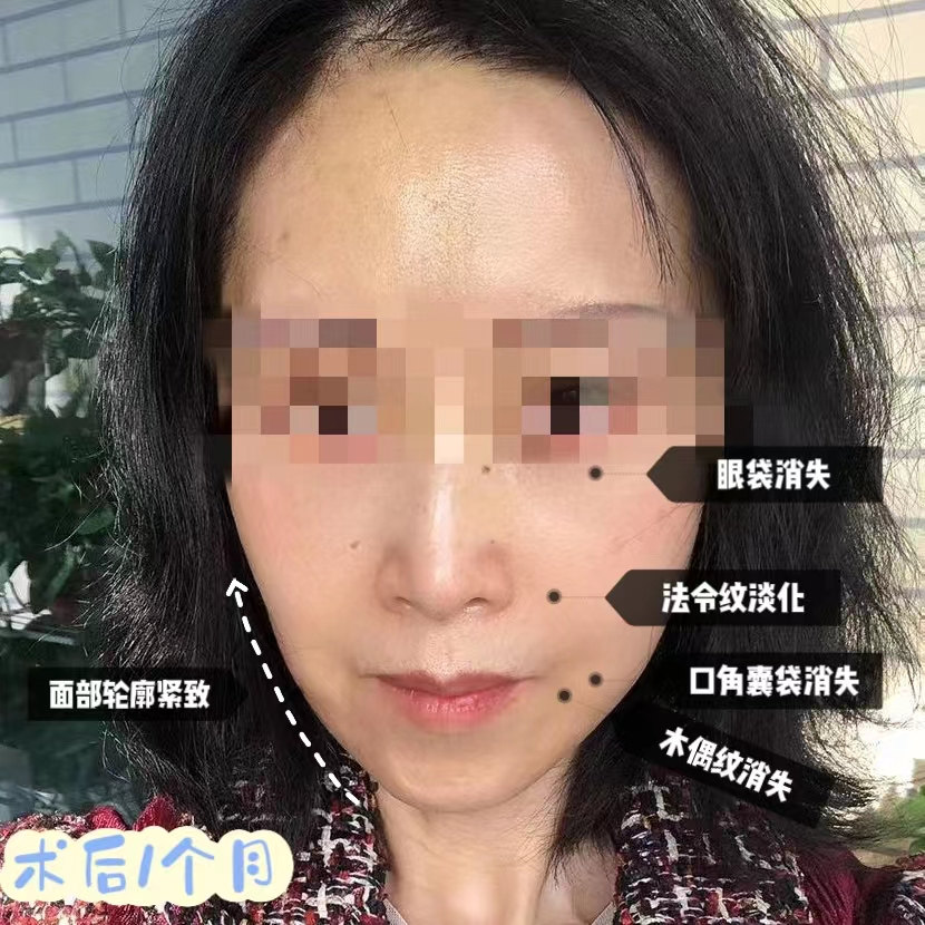 拉皮手术和去眼袋一起做，术后年轻10岁有余！